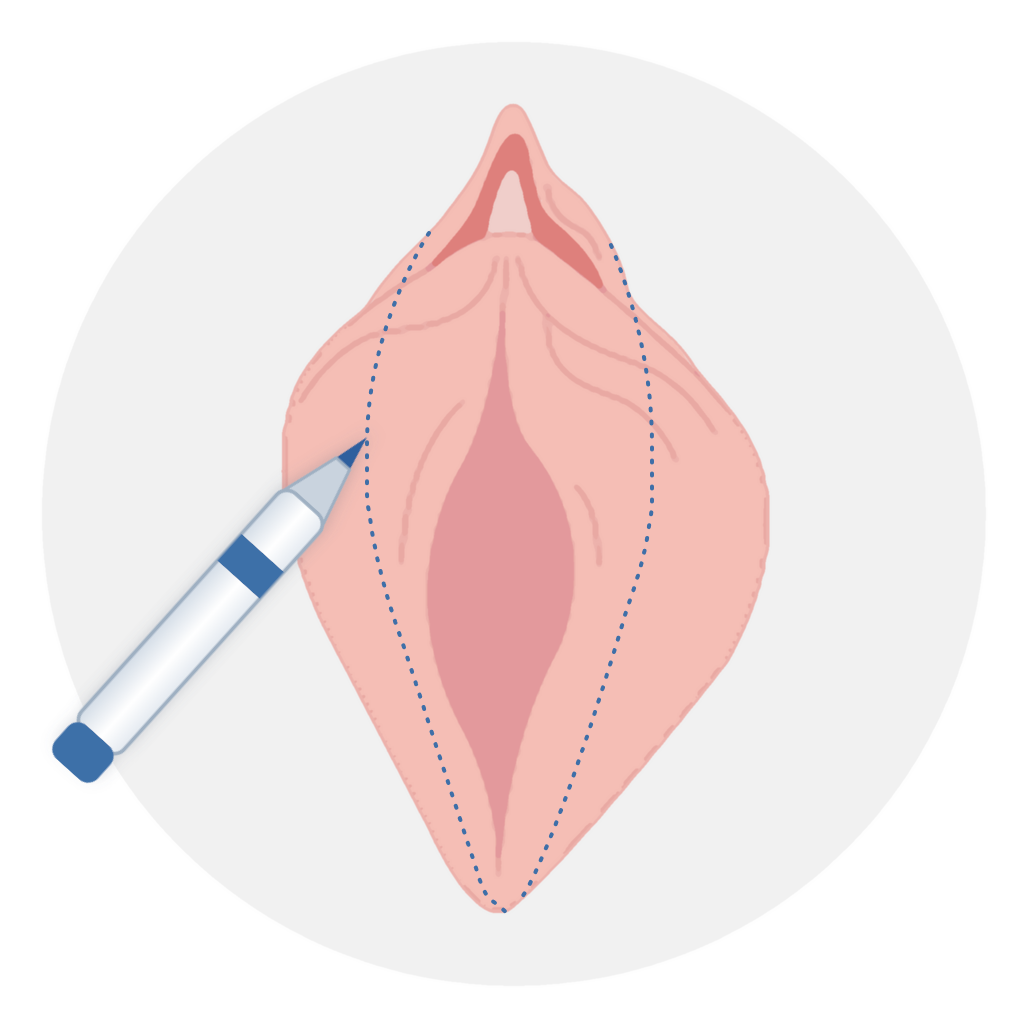 수술과정 STEP 1 절제 범위 디자인