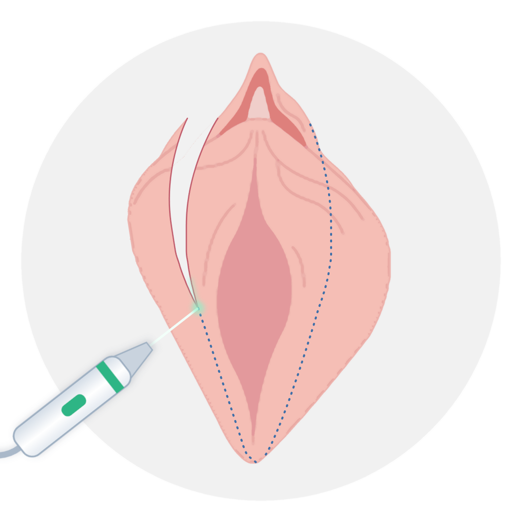 수술과정 STEP 3 정밀 절제